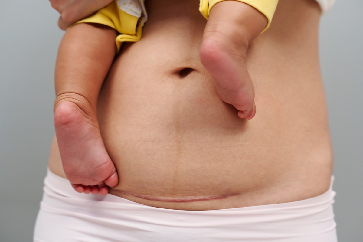 Recovering After a C-Section: What’s Normal and When to Call Your Doctor Recovering After a C-Section: What’s Normal and When to Call Your Doctor
