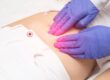 What Are Uterine Fibroids?