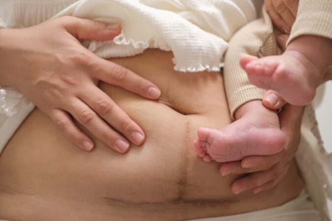 C-Section Recovery Timeline: What to Expect Week by Week