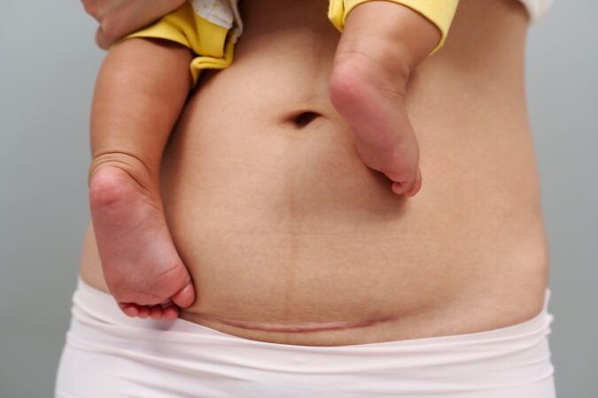 Recovering After a C-Section: What’s Normal and When to Call Your Doctor